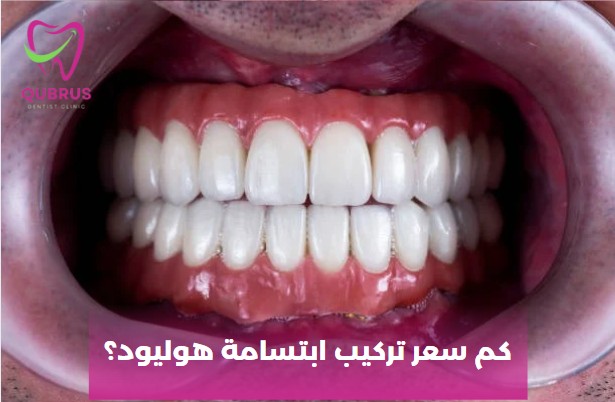 كم تكلف ابتسامة هوليود الطبيعية؟