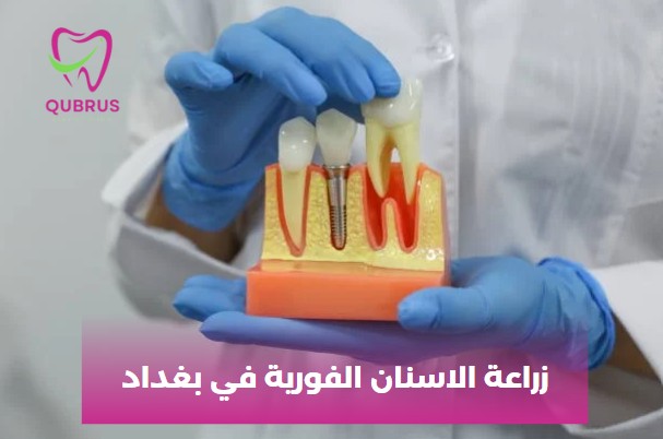 زراعة الاسنان الفورية في بغداد
