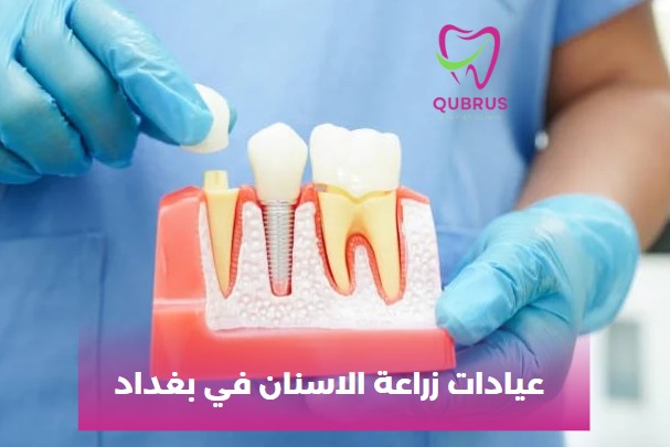 عيادات زراعة الاسنان في بغداد