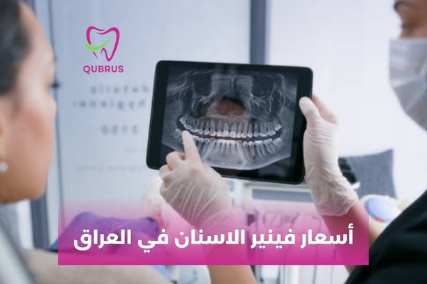 أسعار تغليف الاسنان في العراق
