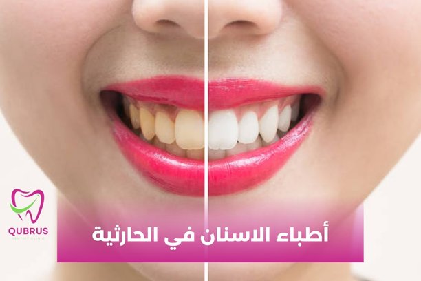 هل ينصح اطباء الاسنان في الحارثية بابتسامة هوليوود ؟