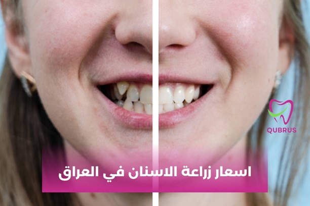 ما هي أفضل غرسات الأسنان الدائمة؟