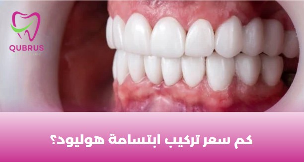 كم سعر تركيب ابتسامة هوليود؟