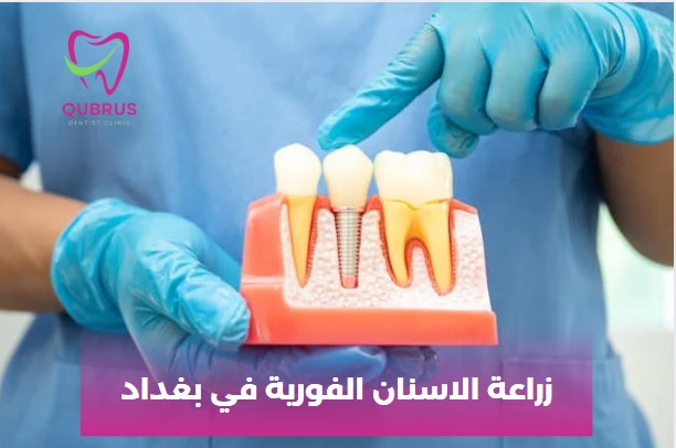زراعة الاسنان الفورية في بغداد