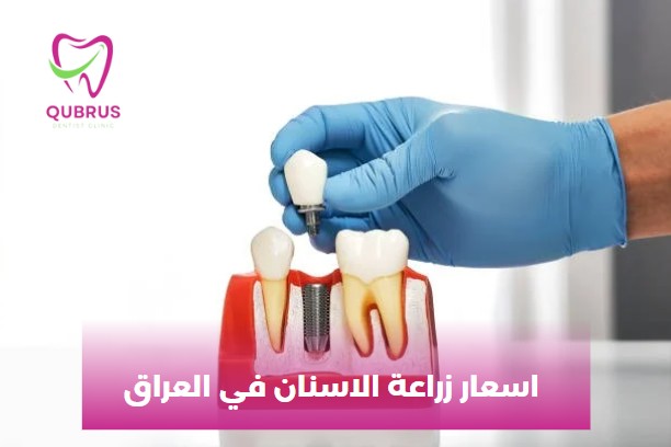 اسعار زراعة الاسنان في بغداد