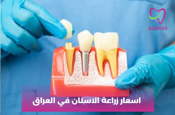 اسعار زراعة الاسنان في العراق