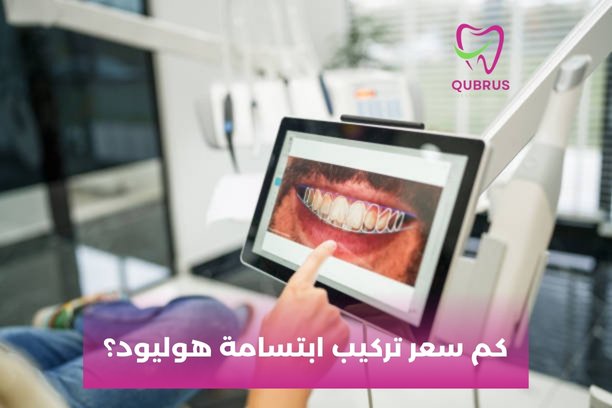 ما هي خيارات تركيب ابتسامة هوليود؟