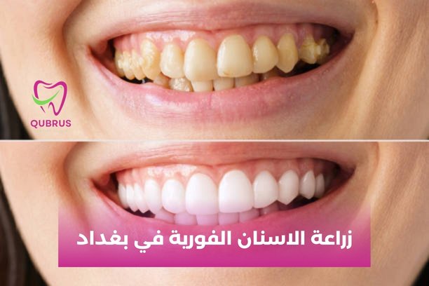 ما هو العمر المناسب لـ إجراء زراعة الأسنان؟