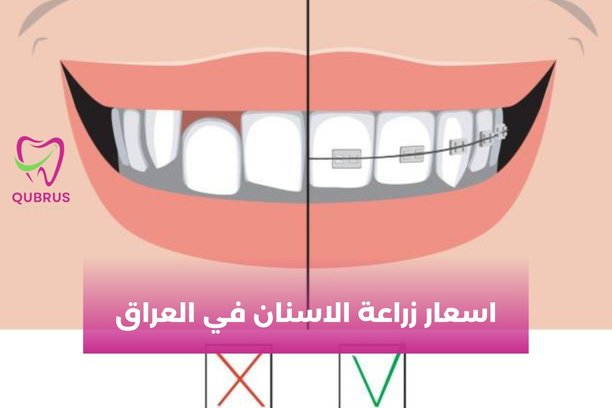 من ماذا تصنع زرعات الأسنان؟