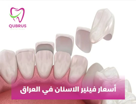 أسعار ابتسامة هوليود في أربيل