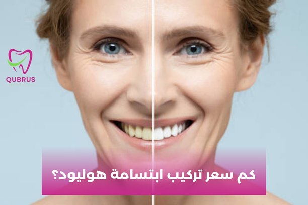 كم جلسة تحتاج ابتسامة هوليود؟