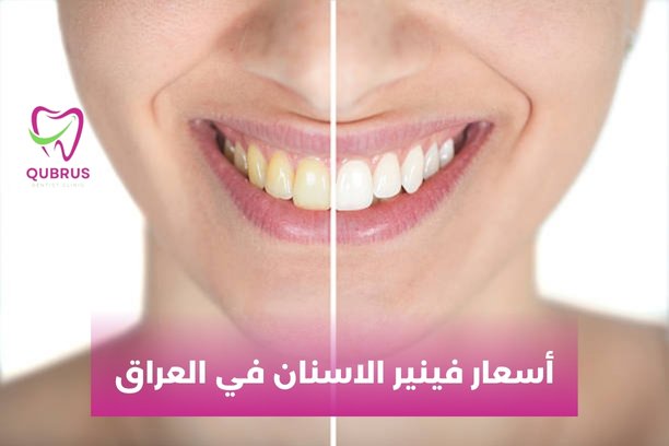 هل هناك أي مخاطر مع زراعة الأسنان؟