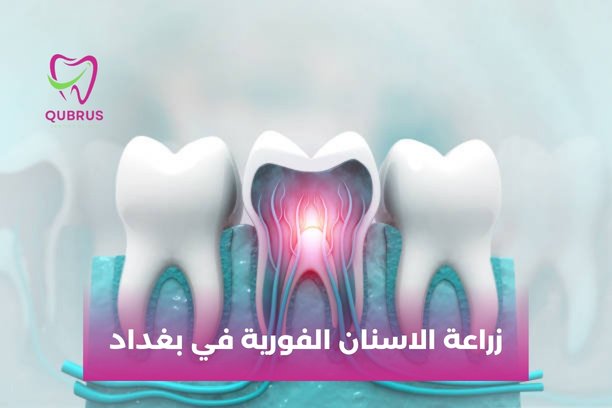 هل يوجد ألم أثناء عملية زراعة الاسنان الفورية في بغداد؟
