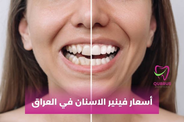 كم تكلفة ابتسامة هوليود في العراق