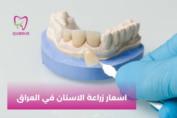 أين أجد أرخص اسعار زراعة الاسنان في العراق؟