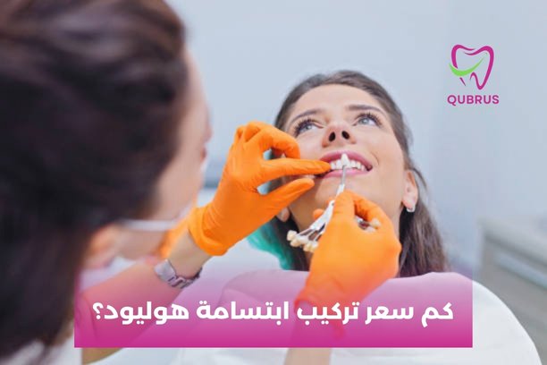 كم مدة بقاء نتائج ابتسامة هوليود؟