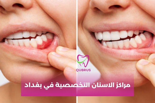 أين المراكز الموجودة في بغداد لزراعة الأسنان؟