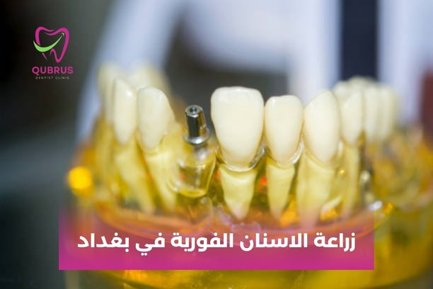 أسعار زراعة الأسنان في بغداد