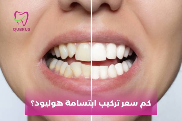 كم سعر تركيب ابتسامة هوليود؟