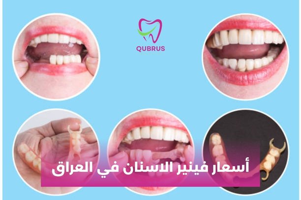 ما هي أسعار تغليف الاسنان في العراق ؟