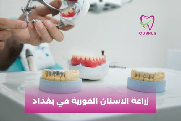 أسعار زراعة الاسنان في بغداد