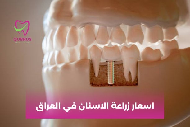 زراعة الاسنان الفورية في بغداد