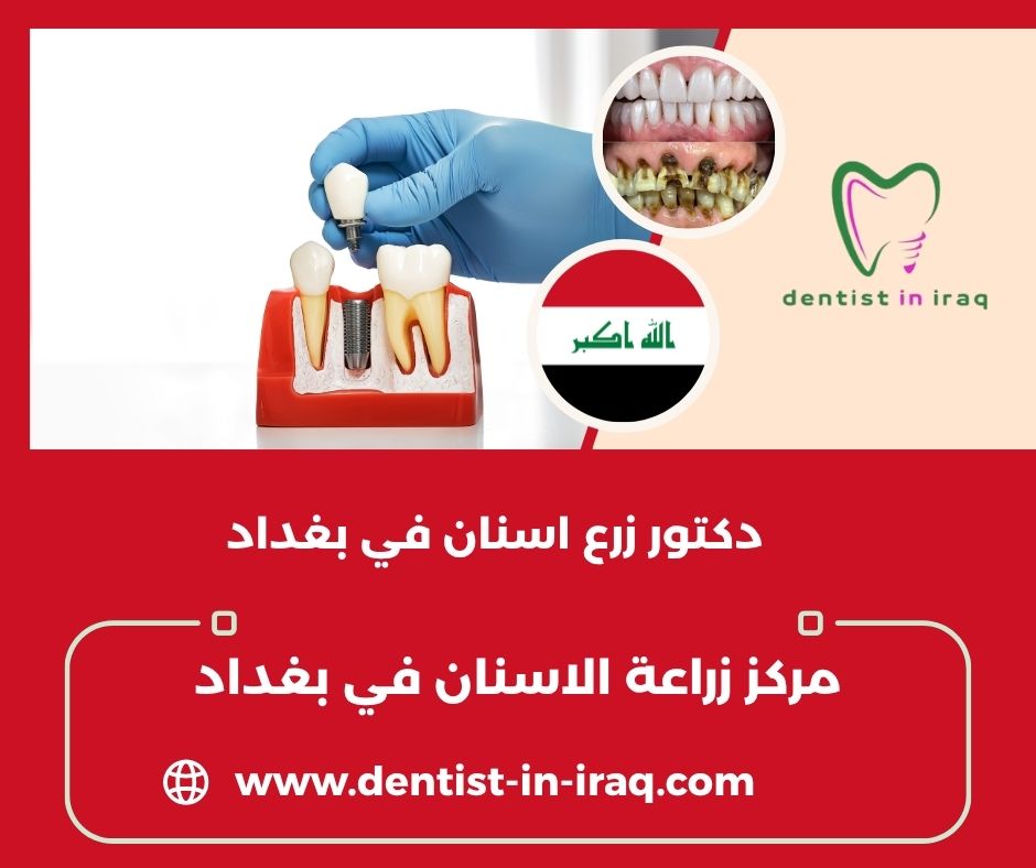 مركز زراعة الاسنان في بغداد مركز زراعة الاسنان في بغداد