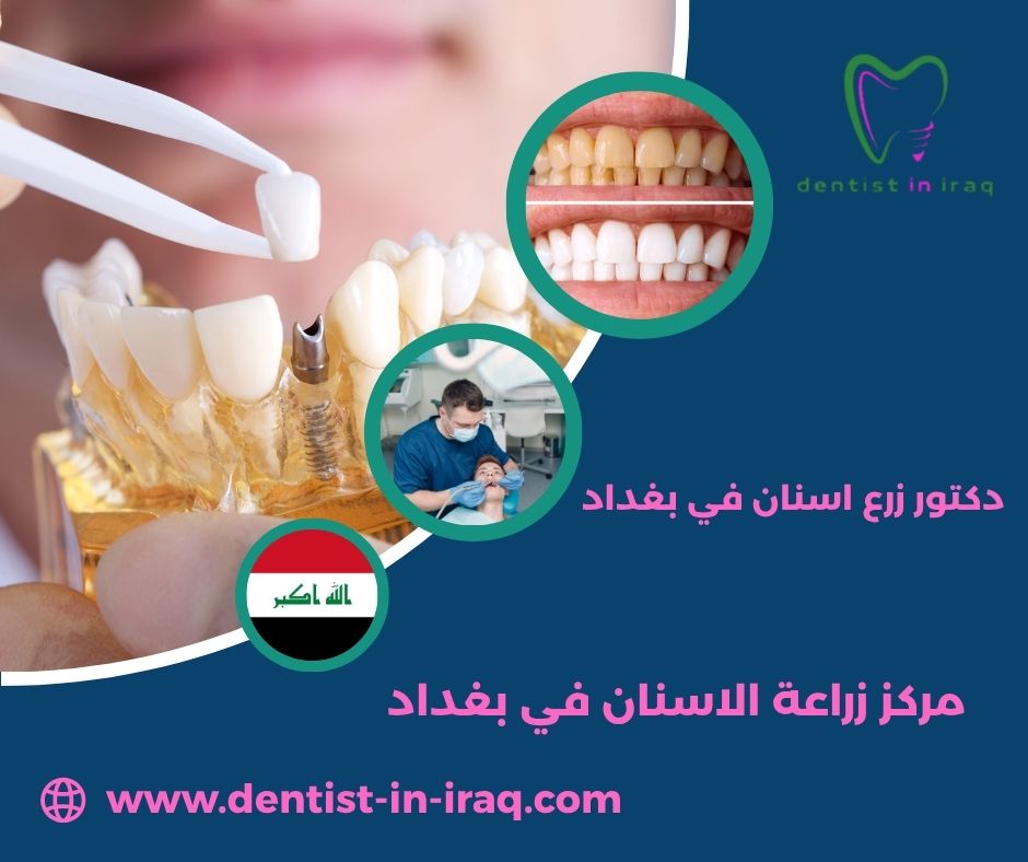 مراكز زراعة الاسنان في بغداد مراكز زراعة الاسنان في بغداد