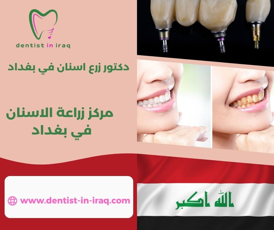زراعة الأسنان في بغداد زراعة الأسنان في بغداد