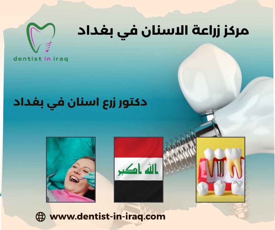 أسعار زراعة الأسنان في بغداد أسعار زراعة الأسنان في بغداد