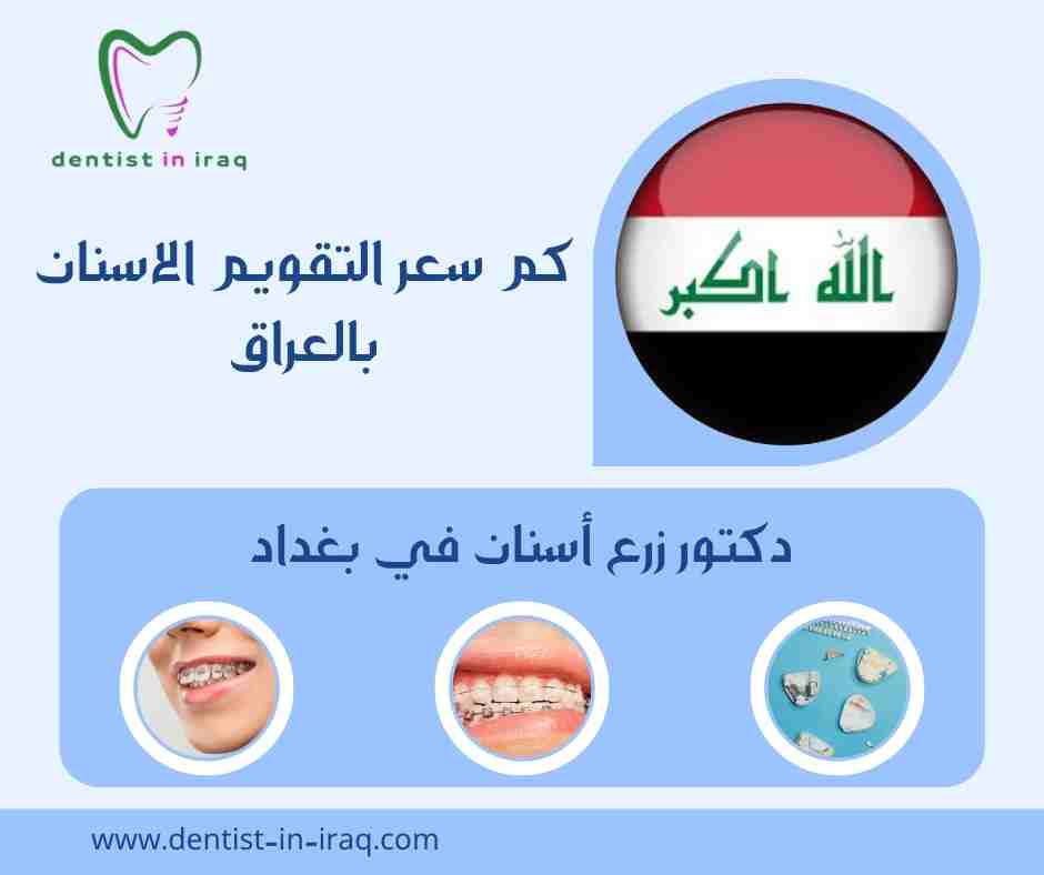 كم سعر التقويم الاسنان بالعراق