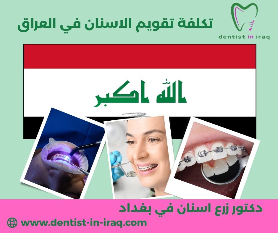 تكلفة تقويم الاسنان في العراق
