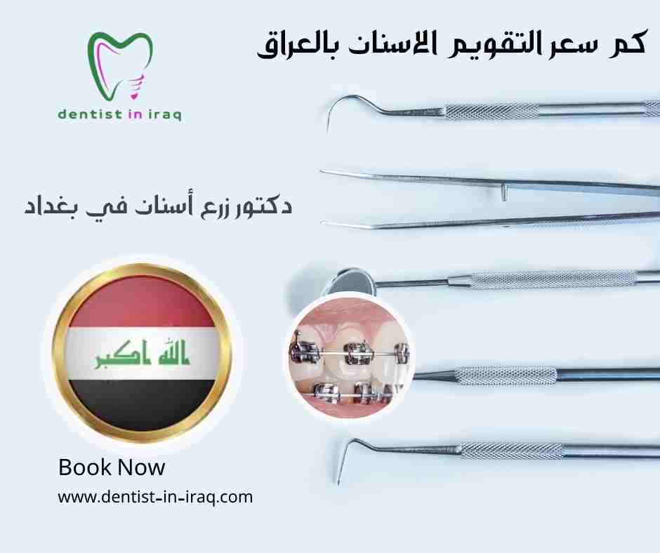كم سعر التقويم الاسنان بالعراق