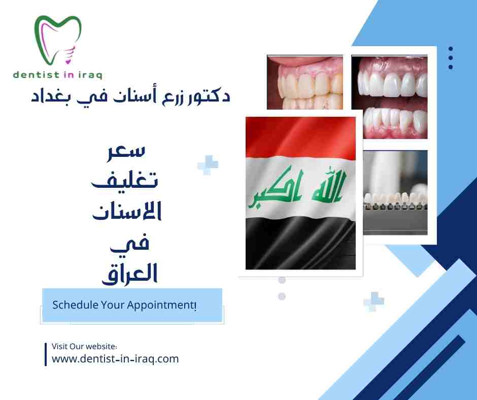 سعر تغليف الاسنان في العراق