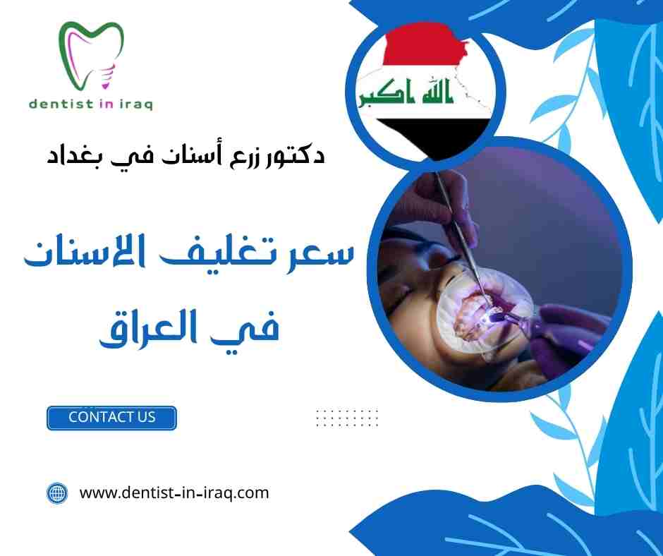سعر تغليف الاسنان في العراق