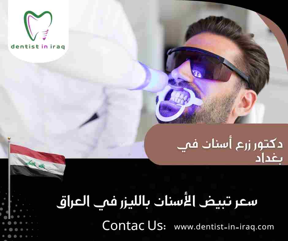 سعر تبيض الأسنان بالليزر في العراق