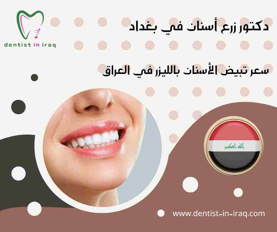 سعر تبيض الأسنان بالليزر في العراق