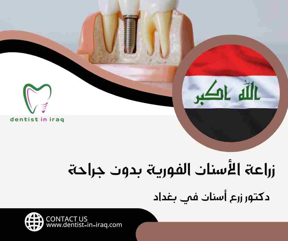زراعة الأسنان الفورية بدون جراحة