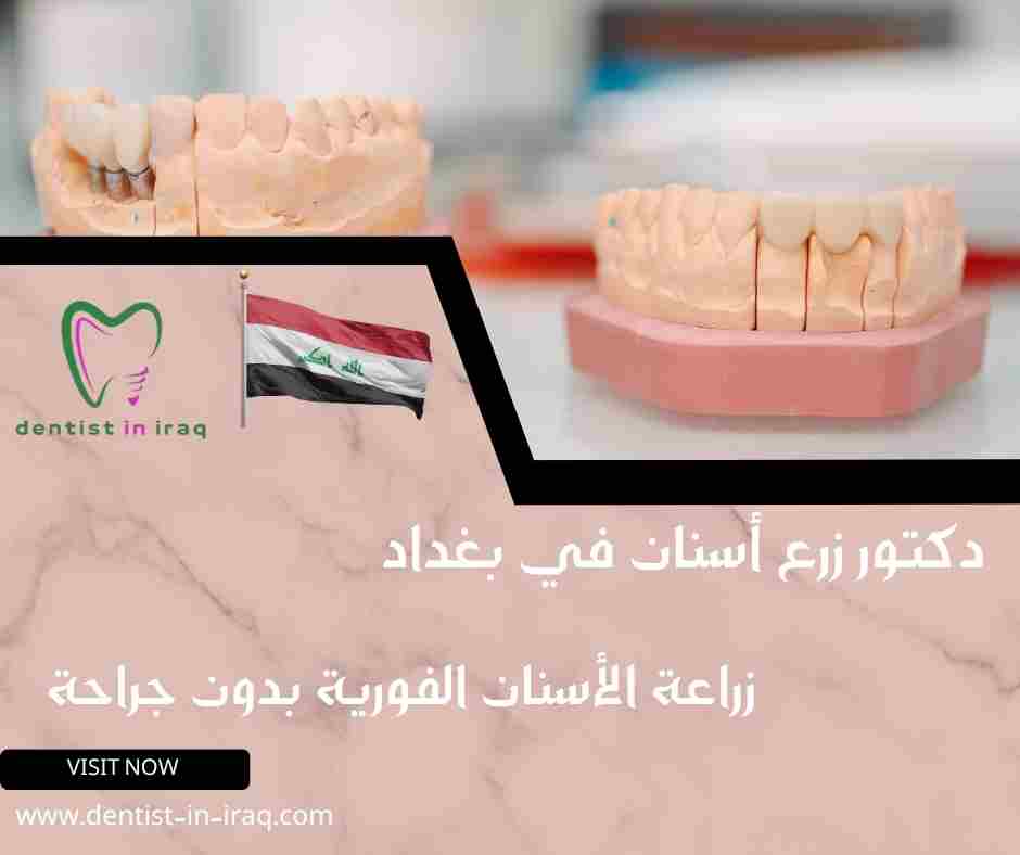 زراعة الأسنان الفورية بدون جراحة