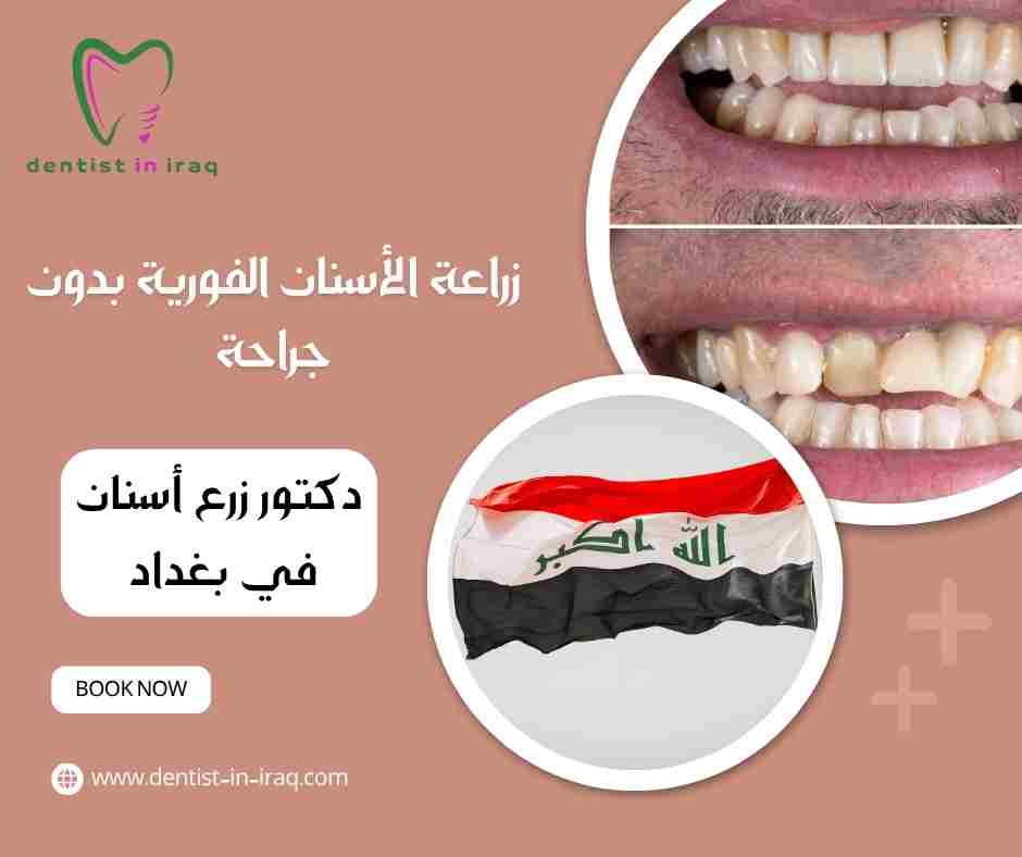 زراعة الأسنان الفورية بدون جراحة