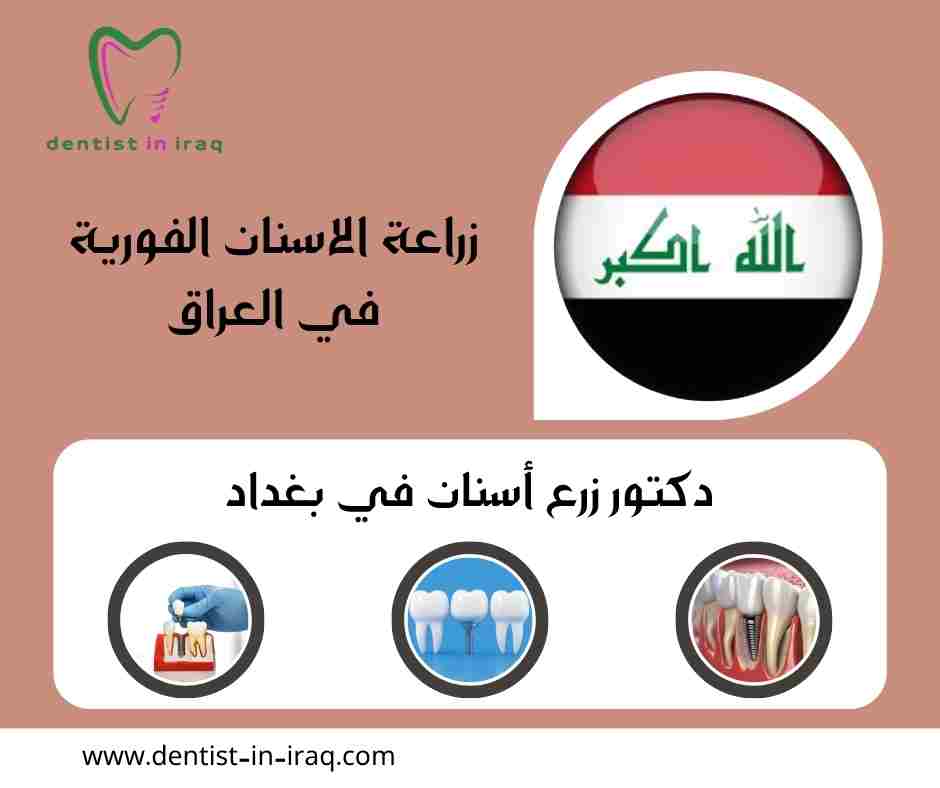 زراعة الاسنان الفورية في العراق