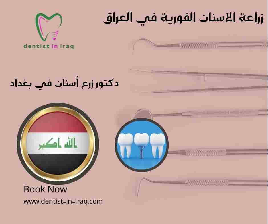 زراعة الاسنان الفورية في العراق
