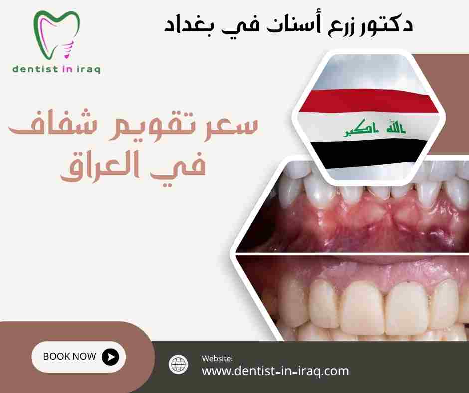 سعر تقويم شفاف في العراق