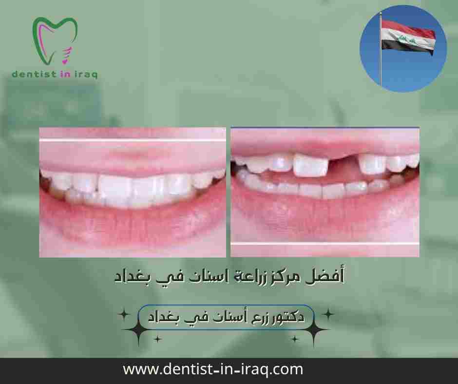 أفضل مركز زراعة اسنان في بغداد