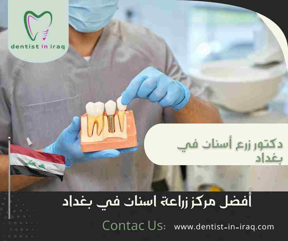 أفضل مركز زراعة اسنان في بغداد