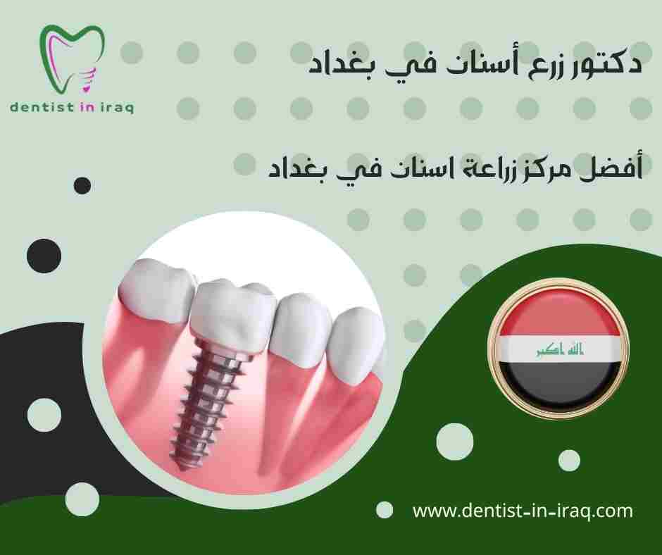أفضل مركز زراعة اسنان في بغداد
