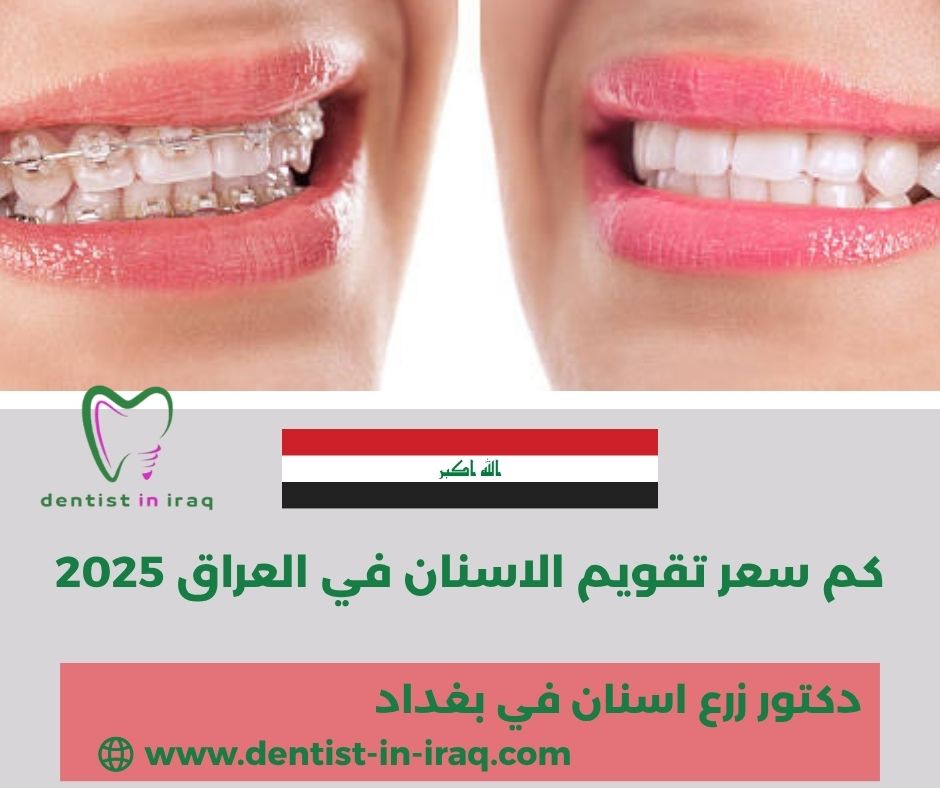 كم سعر تقويم الاسنان في العراق 2025
