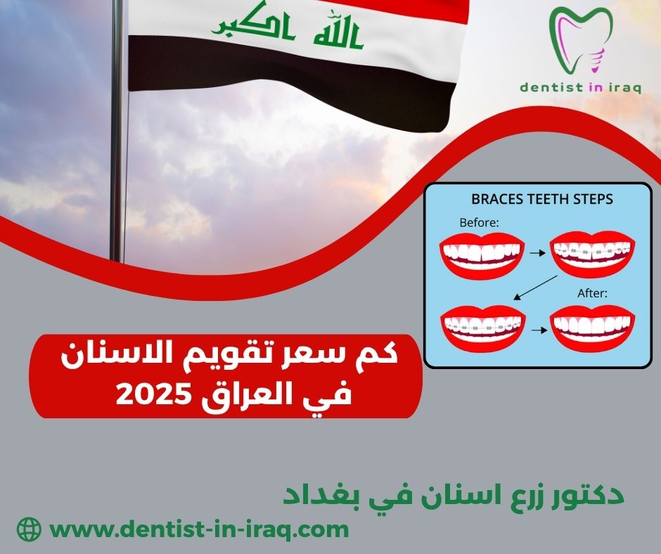 كم سعر تقويم الاسنان في العراق 2025 كم سعر تقويم الاسنان في العراق 2025