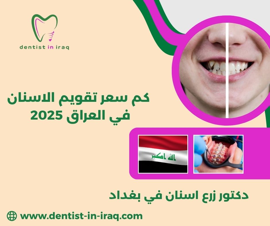 افضل طبيب زراعة اسنان في العراق افضل طبيب زراعة اسنان في العراق