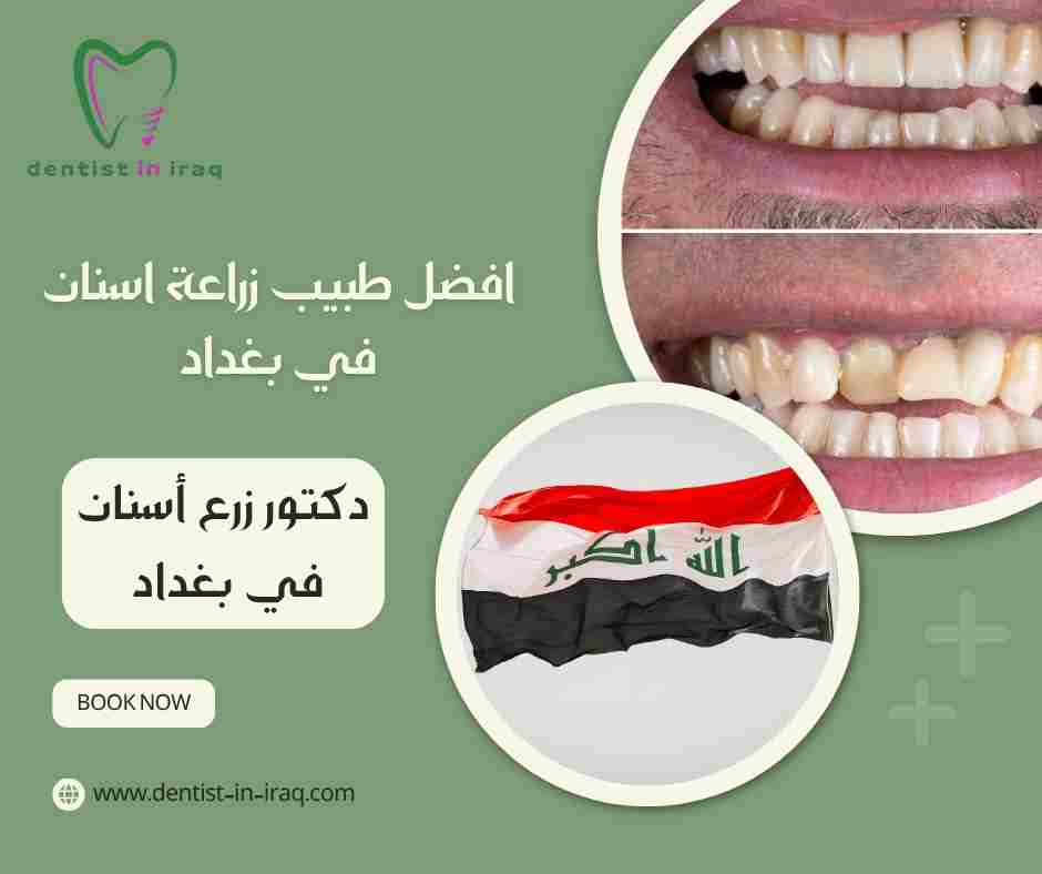 افضل طبيب زراعة اسنان في بغداد
